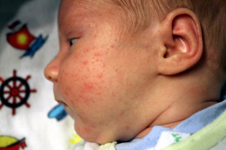 Алергія у новонароджених: симптоми, лікування
