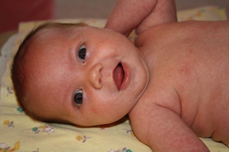 Золотистий стафілокок у немовляти: симптоми і лікування