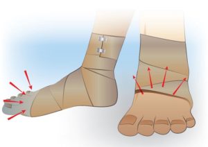 Перша допомога при розтягуванні гомілковостопного і колінного суглобів, основні ознаки