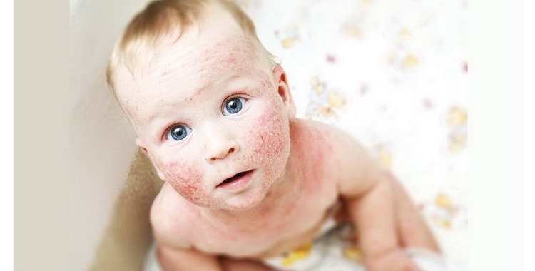 Атопічний дерматит у дітей: як лікувати