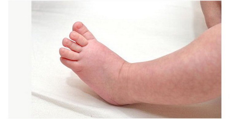 Мармурова шкіра у малюка: чи варто турбуватися