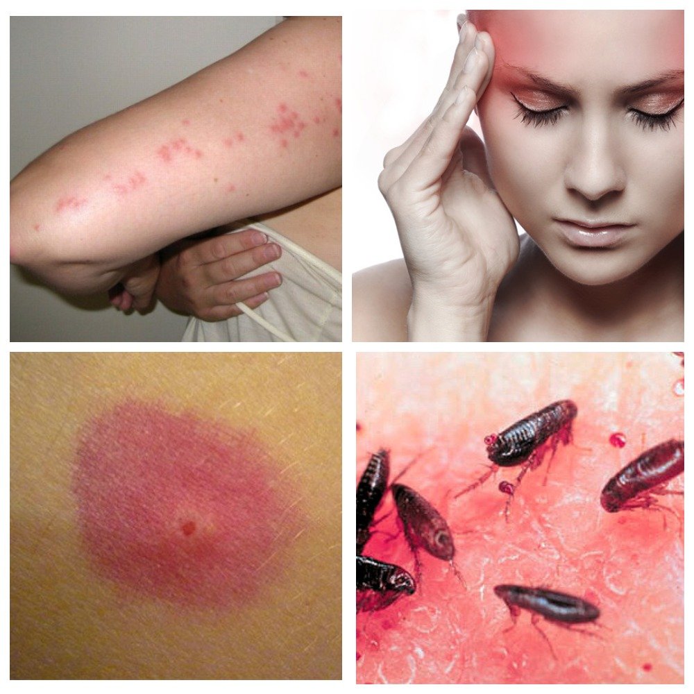 Профілактика інфікування шкіри чим лікувати укуси бліх у людини
