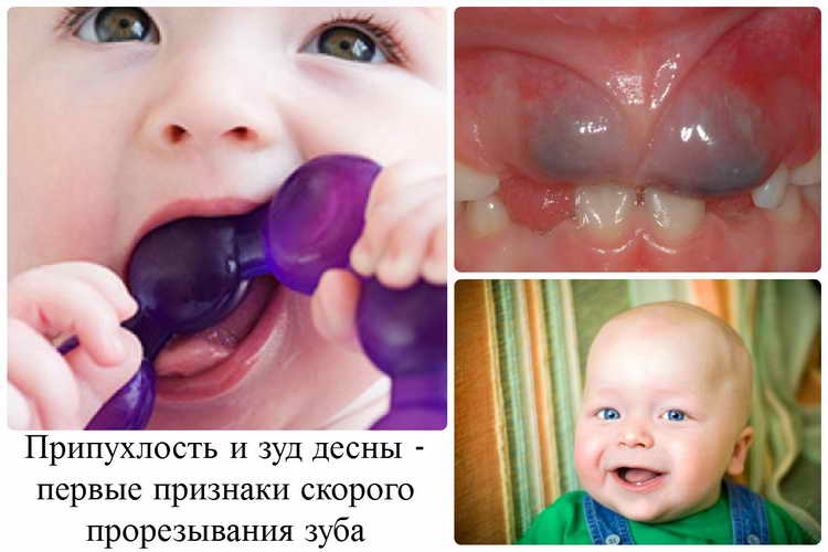 Прорізування зубів у дітей: послідовність і допомогу
