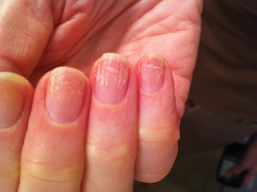 Грибок на пальцях і нігтях рук і між ними: на великому, як виглядає, засоби, методи і способи лікування+ ФОТО 65