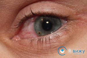 Відчуття стороннього тіла в оці: причини виникнення, лікування, профілактика