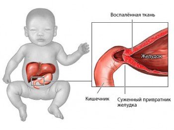 Діагностика та лікування пілоростеноза у немовлят
