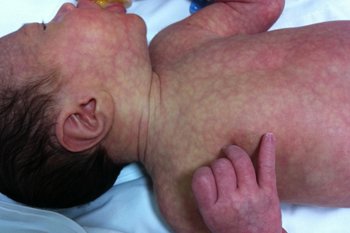Чому виникає мармурова шкіра у новонародженого?