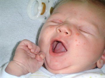 Причини і симптоми діатезу у немовлят