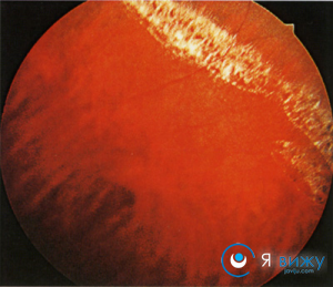Периферична хориоретинальная дистрофія сітківки (ПХРД): причини виникнення, прояви, діагностика, лікування, профілактика