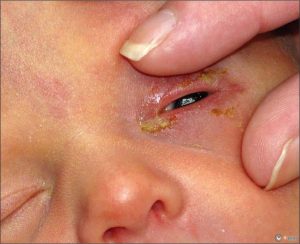 Чому гнояться очі у дитини (вранці, у немовляти, у немовляти) і чим лікувати