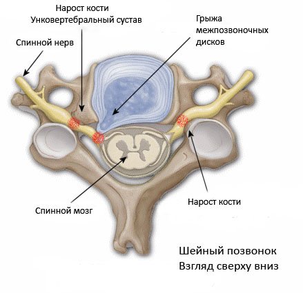 Унковертебральный артроз шийного відділу хребта: лікування, що це таке, симптоми