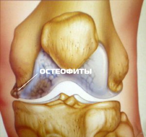 Що таке остеофіти колінного суглоба і як з ними боротися?
