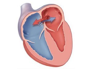 Причини і симптоми розвитку вроджених вад серця у малюків
