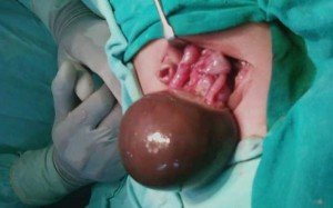 Порожнинна операція з видалення кісти яєчника