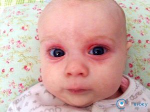 Червоність під очима у дитини можливі причини та лікування, міри профілактики, поради, фото)