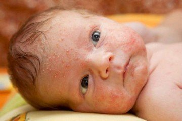 Причини і симптоми цвітіння у немовлят