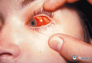 Крововилив в око (сітківку, склеру, конюнктиву, внутрішнє, навколо очей): причини, симптоми, лікування, фото
