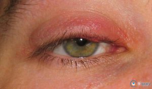 Червоні очі і опухлі повіки причини, супутні симптоми (болять, сверблять повіки і очі)