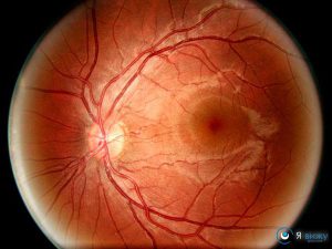 Захворювання сітківки ока назви, симптоми, причини, лікування