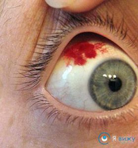 Червоні судини на білках очей причини, наслідки, лікування (краплі, компрес, фото)