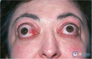 Ендокринна офтальмопатія: причини виникнення, прояви, діагностика, лікування, профілактика