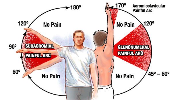 Травми плеча: як визначити і лікувати травми плечового суглоба