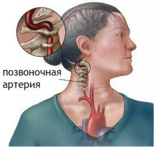 Синдром хребетної артерії при шийному остеохондрозі: лікування, симптоми, діагностика