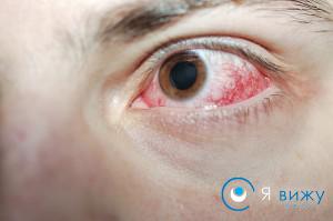 Опік очей: причини виникнення, прояви, діагностика, лікування, профілактика