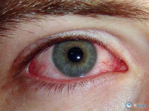 Пісок в очах: причини виникнення, прояви, діагностика, лікування, профілактика