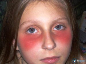 Під очима червоні плями, що лущаться, сверблять, припухло у дорослого або дитини: чим лікувати
