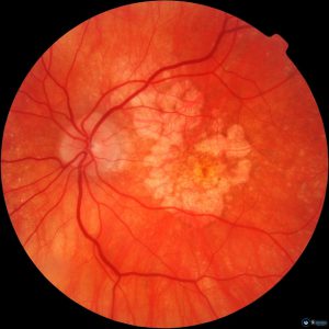 Дистрофія сітківки ока: причини захворювання, діагностика, лікування