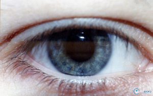 Застійний диск зорового нерва: причини виникнення, лікування, профілактика