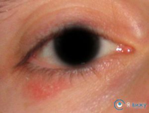 Червоні плями під очима на вилицях причини, лікування (мазь, народні методи)