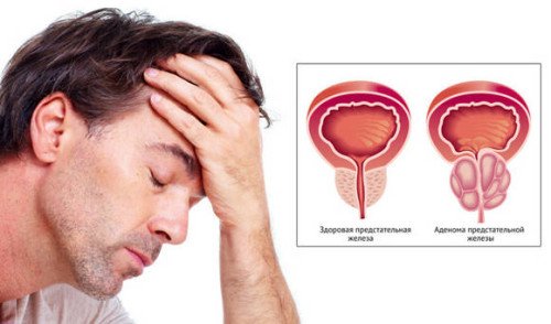 Часте сечовипускання у чоловіків: причини та способи лікування