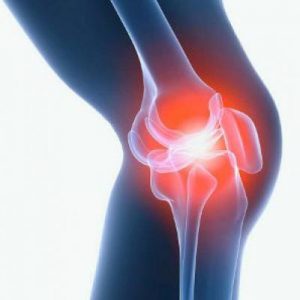 Що таке остеофіти колінного суглоба і як з ними боротися?