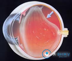 Розшарування сітківки ока причини, симптоми, лікування (варіанти операції, ціна)