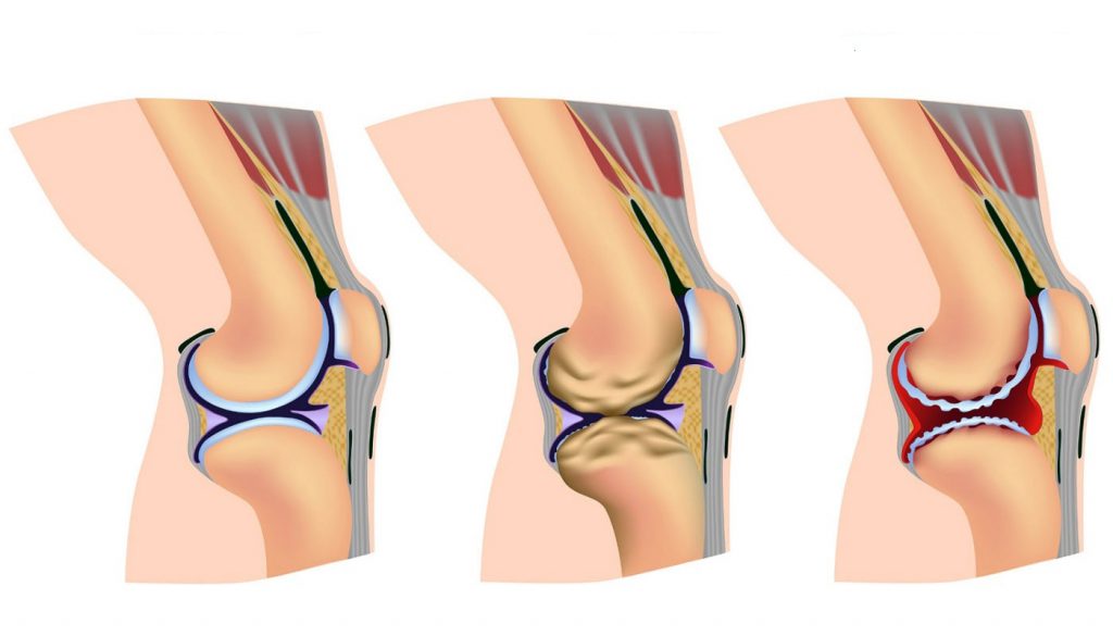 Остеохондроз колінного суглоба 2 ступеня: симптоми, лікування, фізіотерапія