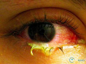 Гнійні виділення з очей: причини виникнення, прояви, діагностика, лікування, профілактика