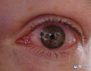 Почервонів очей що робити: способи швидкого зняття симптому (народні, лікарські)