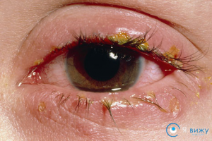 Хвороби очей у людини рогівки, сітківки, інфекційні (назви, симптоми, лікування, фото)