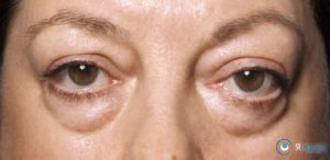 Набряк очі що робити і чим лікувати набряк при алергії, інфекції, захворюваннях внутрішніх органів