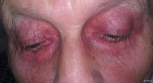 Руйнування очі: причини виникнення, прояви, діагностика, лікування, профілактика