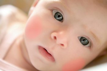 Основні симптоми алергічної реакції у новонароджених