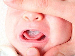 Симптоми і способи лікування стоматиту у новонародженого