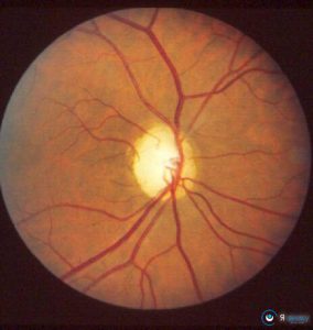 Застійний диск зорового нерва: причини виникнення, лікування, профілактика