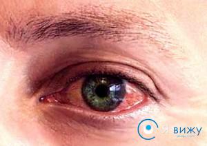 Червоні очі: причини виникнення, прояви, профілактика, лікування