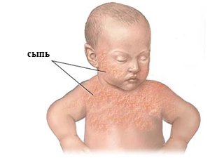Причини появи гормональної висипу у немовлят
