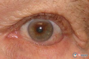 Хвороби повік очей нижнього, верхнього (фото, лікування)