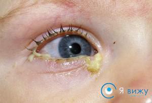 Виділення з очей: причини виникнення, прояви, діагностика, лікування, профілактика