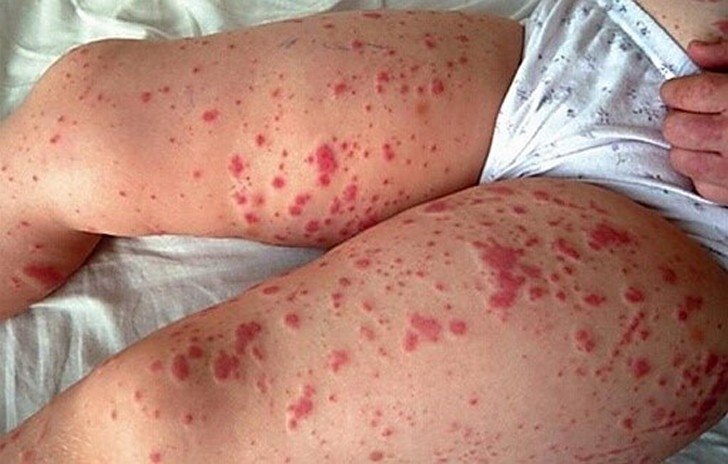 Види висипки у дитини на ногах і ступнях з фото і поясненнями: ознаки алергії і інфекційних захворювань